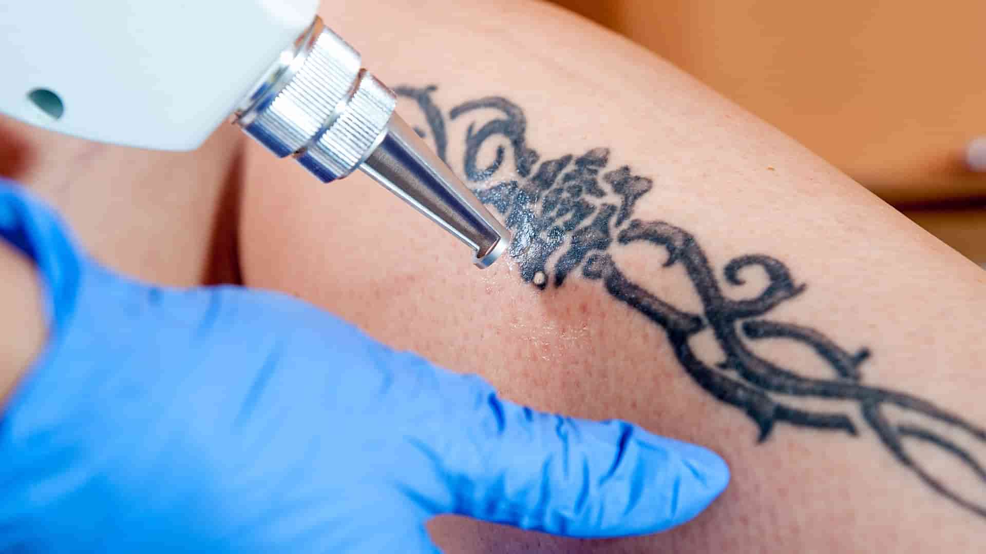 Tattoo Removal FAQs [Pricing, Side Effects, Aftercare & More!] | LaserAll